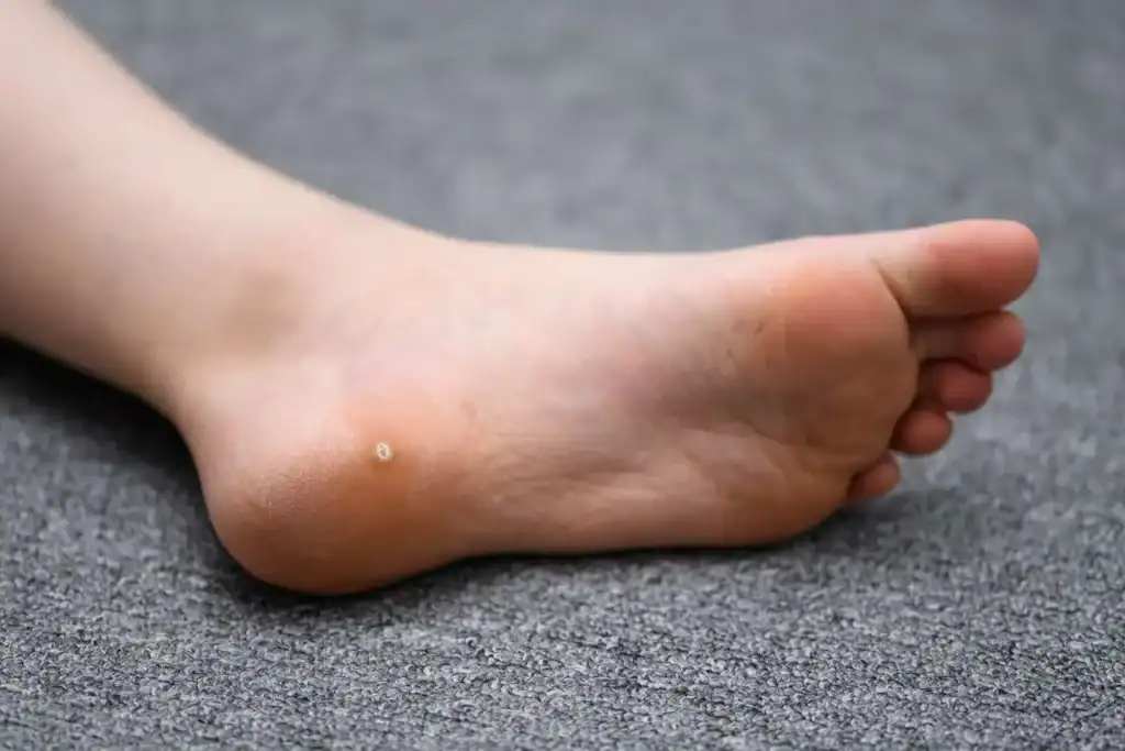 Cryotherapy For Warts And Also Verrucas 2 Image of verruca on the bottom of the foot that able to be treated with Cryotherapy Epping