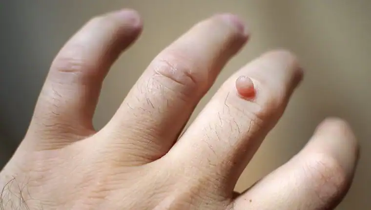 Image of blemish that Cryotherapy Epping can remove with Lipo 360.