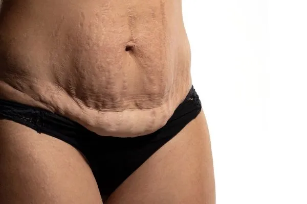 The science behind skin tightening Epping picture of a woman's sagging skin on the stomach